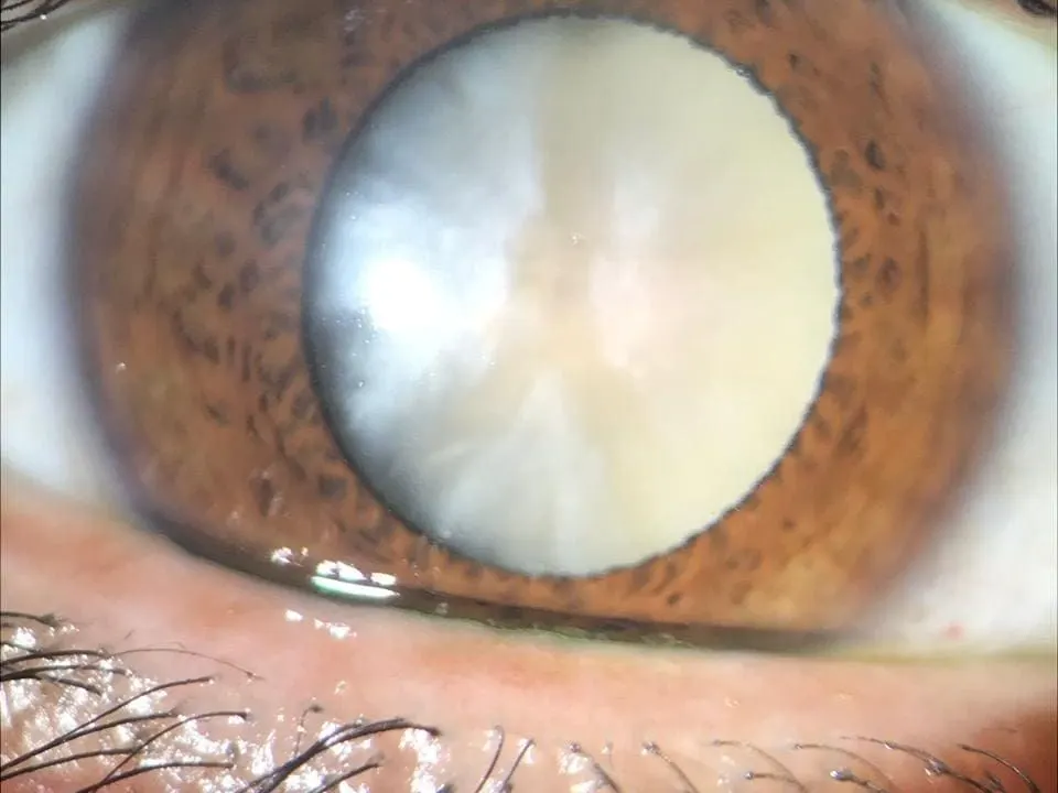 Ojo con catarata total: el cristalino se ve blanco detrás de la pupila