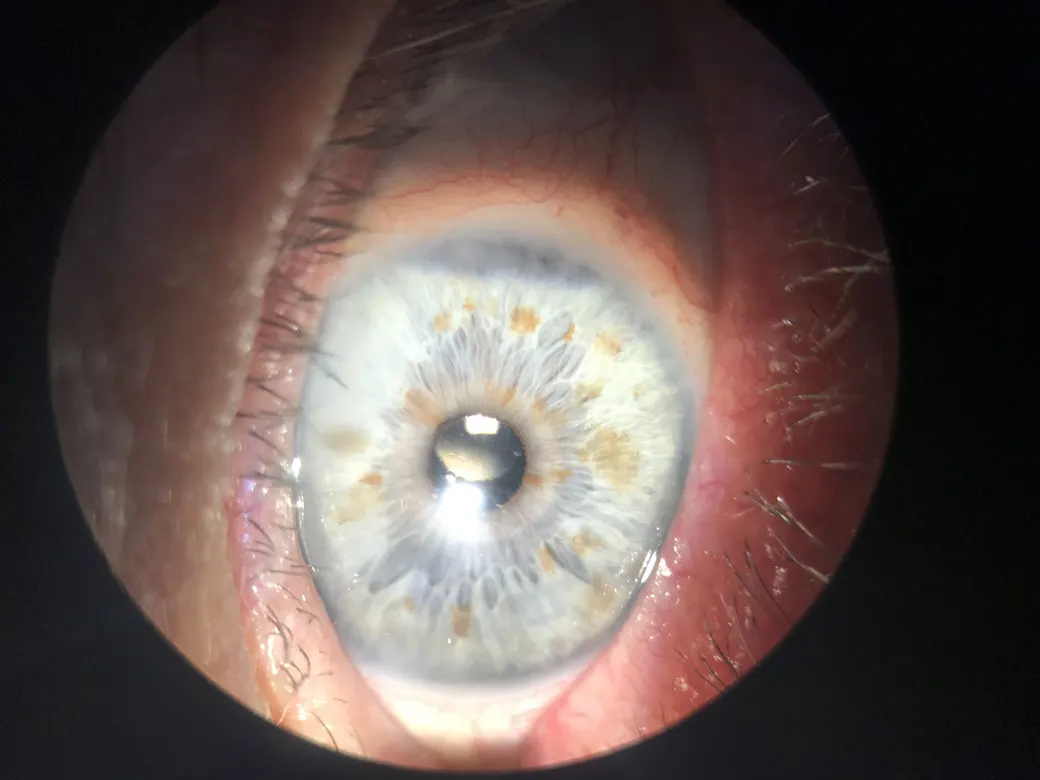Ojo después de la cirugía de catarata, con la pupila ya transparente