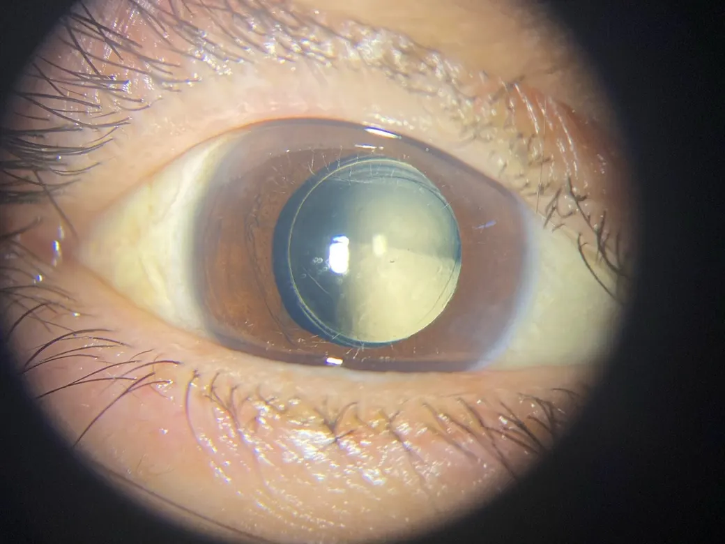 Lente intraocular monofocal ya implantado, visto con lámpara de hendidura