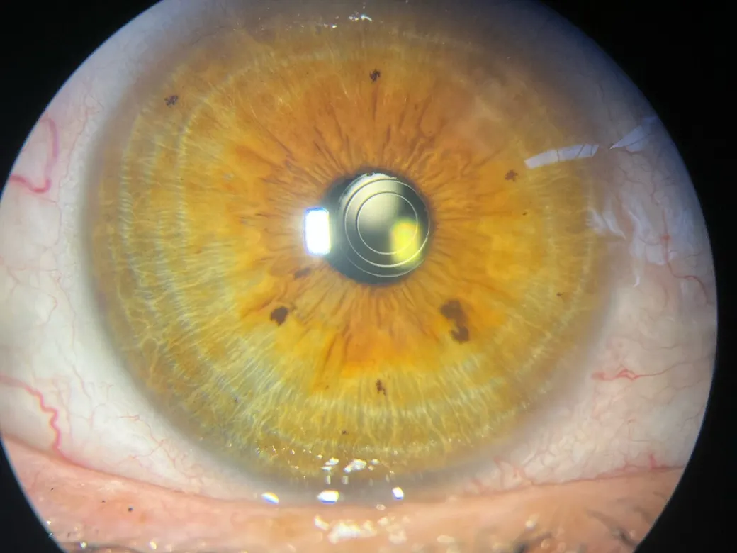Lente intraocular trifocal implantado, con sus anillos visibles en la pupila