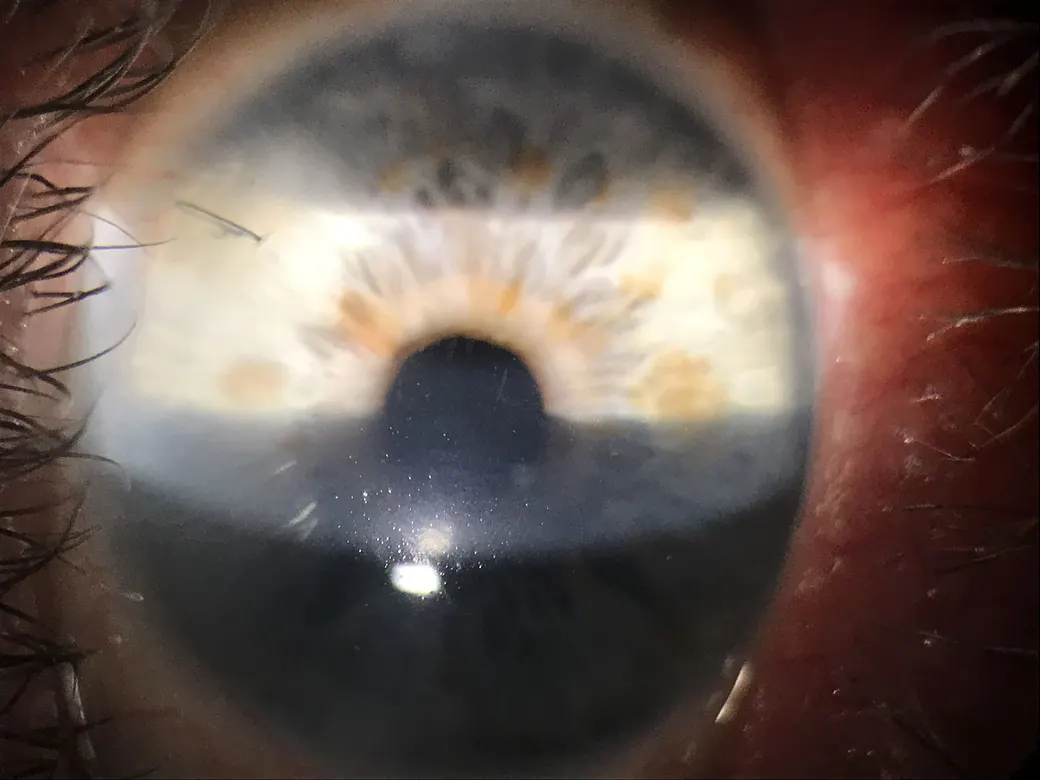 Ojo después de la cirugía de catarata, con la pupila ya transparente