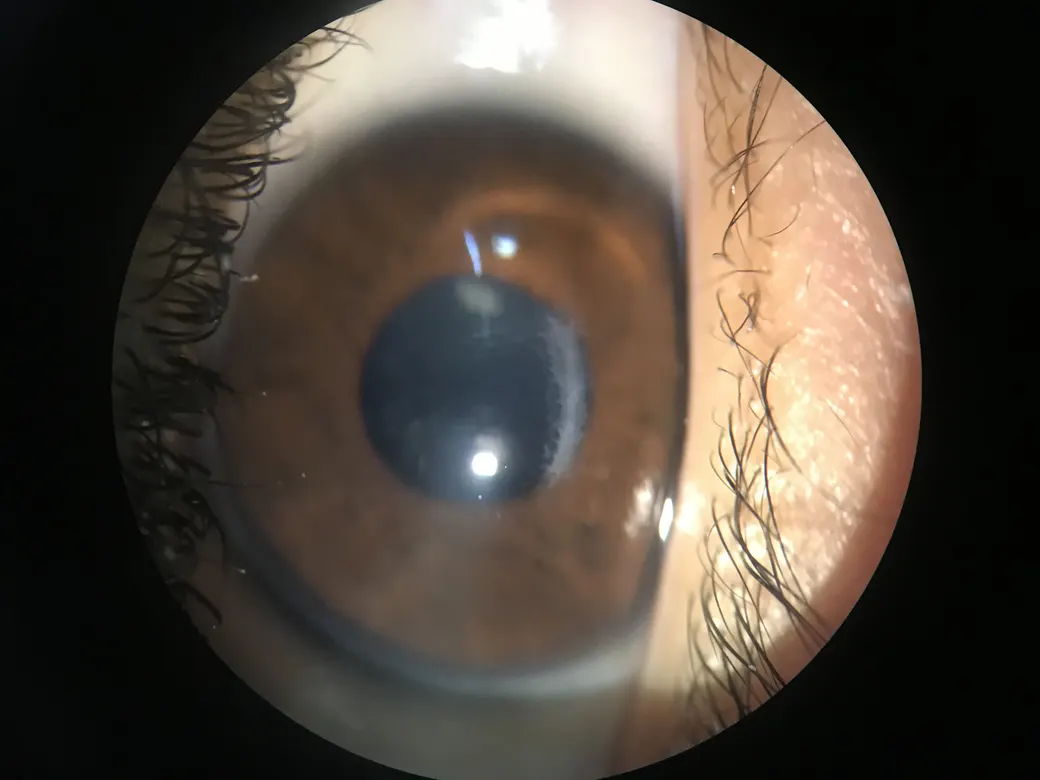 Córnea con queratocono avanzado vista con lámpara de hendidura