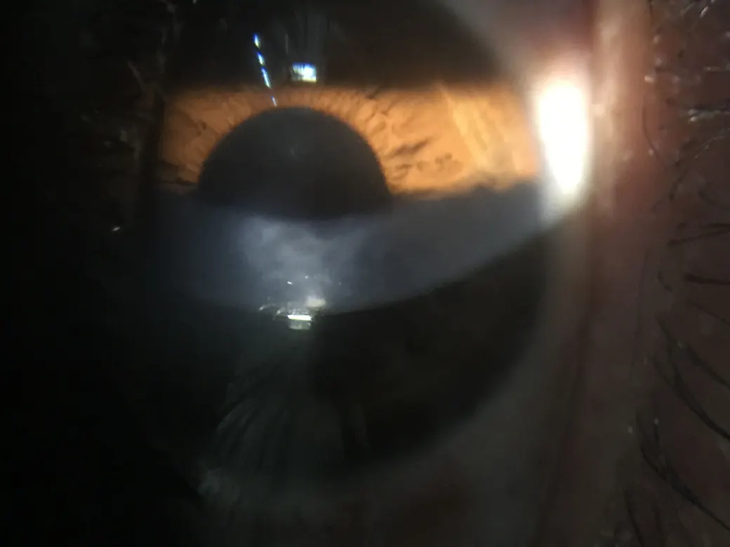 Perfil de la córnea con queratocono visto con lámpara de hendidura
