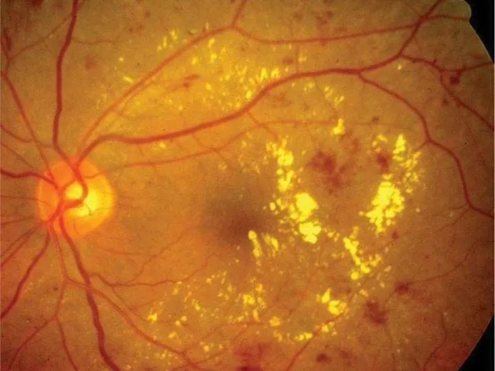 Fondo de ojo con retinopatía diabética: exudados amarillos y hemorragias