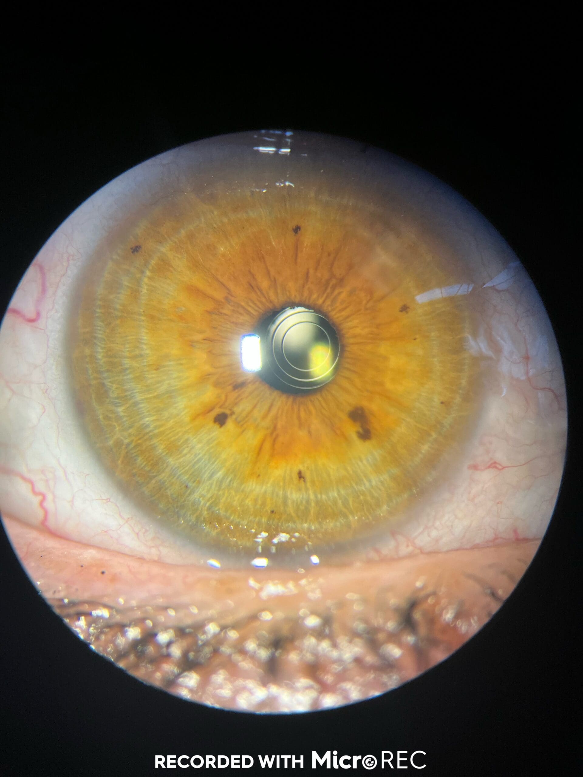 Lente intraocular multifocal trifocal para visión de lejos, media e intermedia