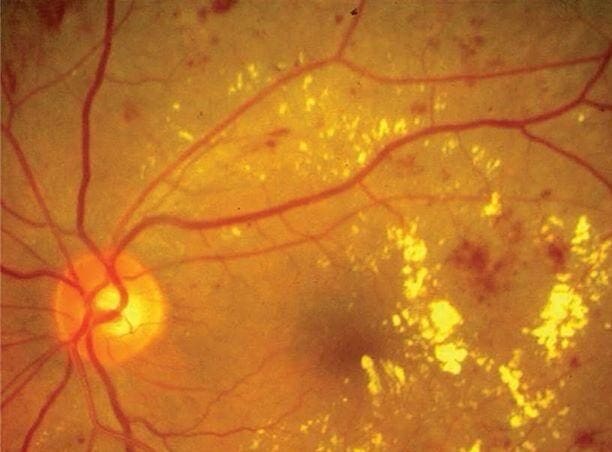 Imagen de retinopatía diabética en fondo de ojo