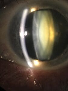 CIRUGÍA DE CATARATAS