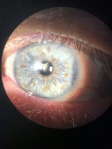 DESPUÉS CIRUGÍA DE CATARATAS