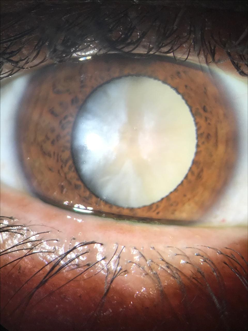 Examen oftalmológico para diagnóstico de ojo seco crónico
